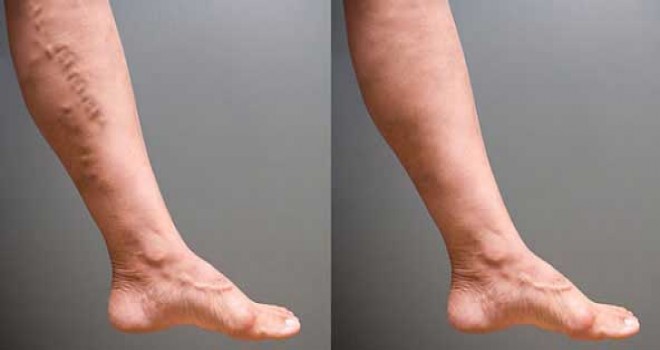 Ameliyatsız İç Varis Tedavisi