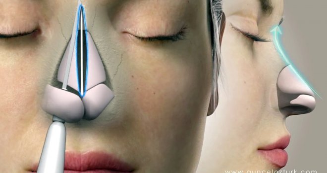 Burun Estetiği ile Şekil ve İşlev Düzeltme