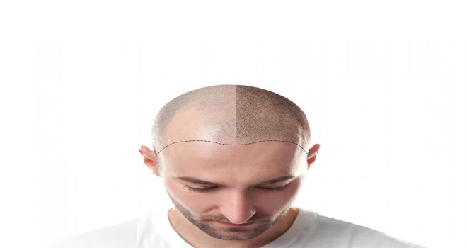 Saç Ekimi Sonrası Saç Telleri Ne Zaman Çıkar?