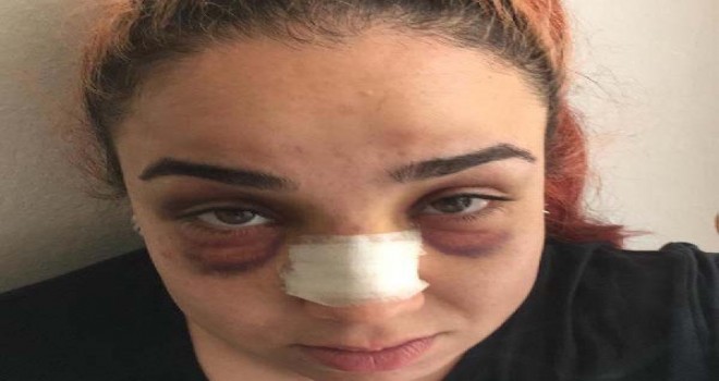 Çalışanının burnunu kıran patrona 4,5 yıla kadar hapis istemi