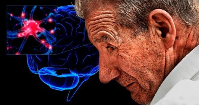 Hareketli yaşam, parkinsonun ilerlemesini yavaşlatıyor