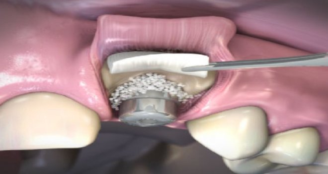 Kalçadan, sığırdan çene kemiği nakli