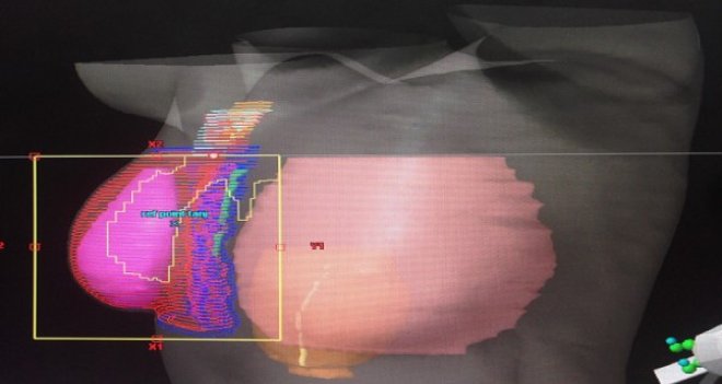 Prof.Görken: Radyoterapi korkulacak bir yöntem değildir