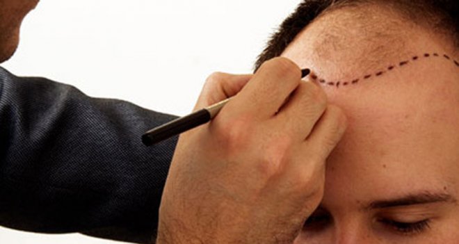 Saç ekiminden sonra kurallara uymak önemli