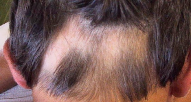 Saçkıran'ın tedavisi mümkün