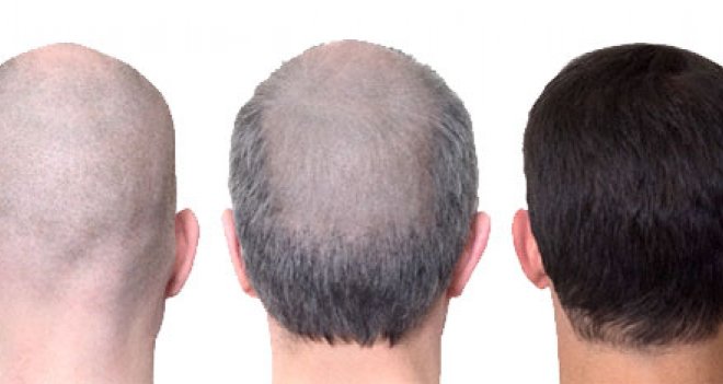 Sıcak havalar saç ekimine engel değil