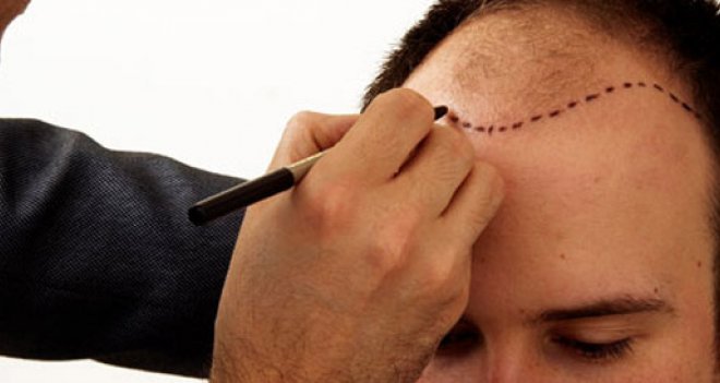 Soğuk havalarda saç ekimi daha etkili